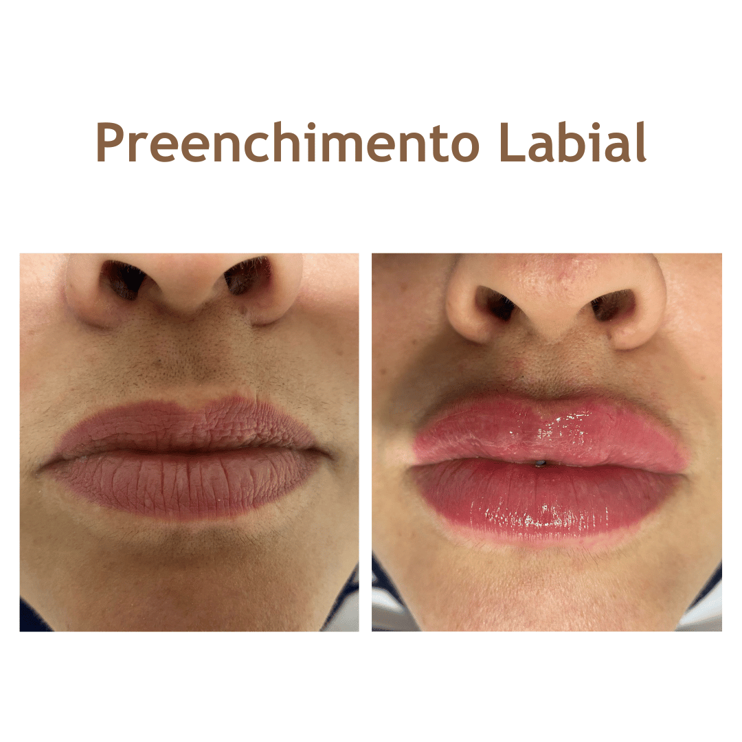 Preenchimentolabial-site