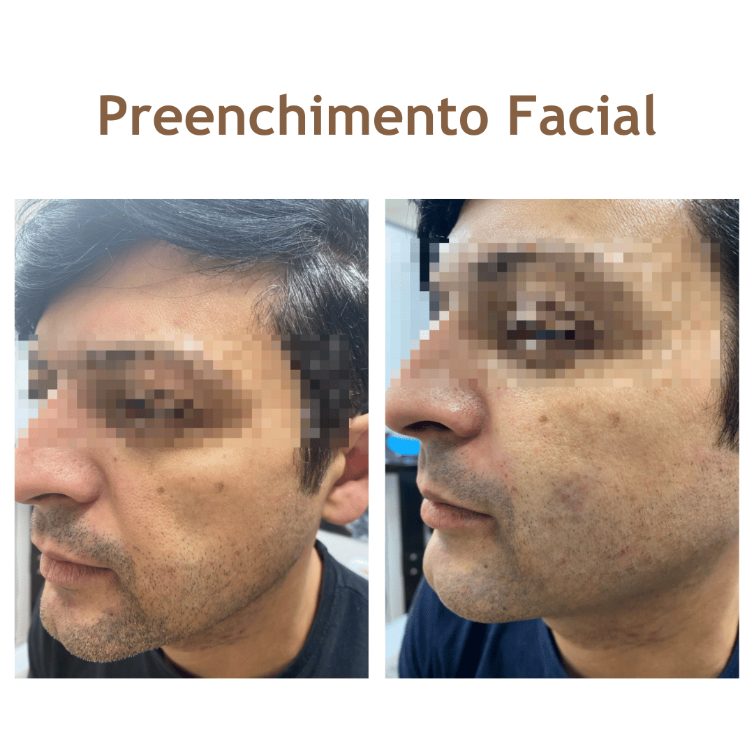 preenchimentofacial-site