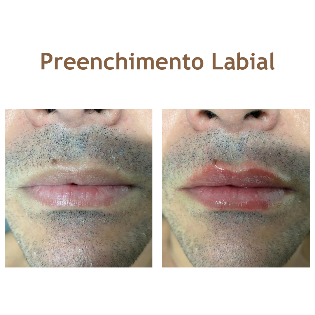 preenchimentolabial-sitereviva
